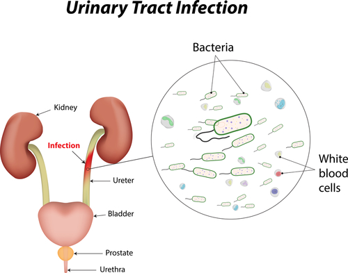 infectii vezica urinara simptome