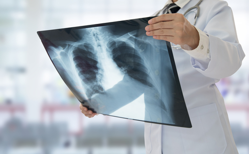  Tuberculoza pulmonara la adult, simptome si diagnostic