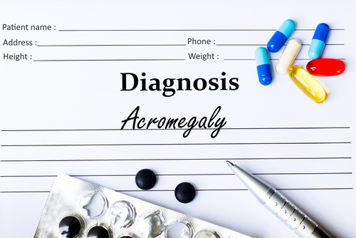  Acromegalia – cauze, manifestări, tratament