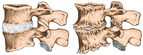 Deformarea artrozei simptomelor articulației șoldului de gradul 1