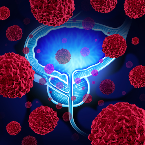 Progrese în tratamentul cancerului de prostată - Viața Medicală
