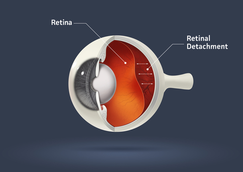  Dezlipirea de retină – de ce este atât de periculoasă?