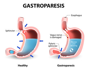  Gastropareza şi în special, gastropareza diabetică