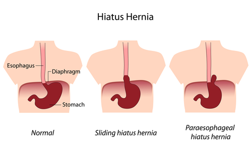  Hernia hiatală- clasificare și tratament