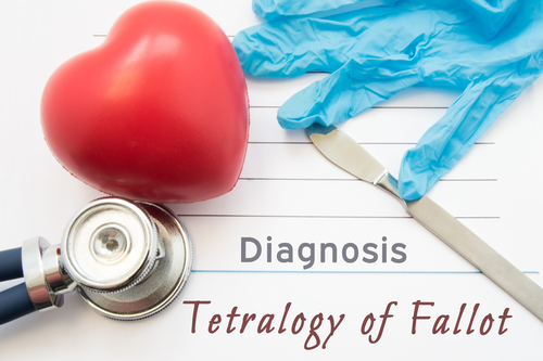  Tetralogia Fallot – simptome, diagnostic, tratament