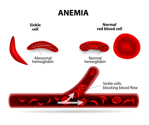anemie eritrocitara)