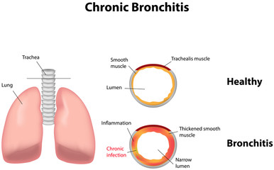  Bronsita cronica- cauze, diagnostic și tratament