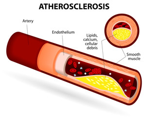 cum se tratează ateroscleroza varicoasă