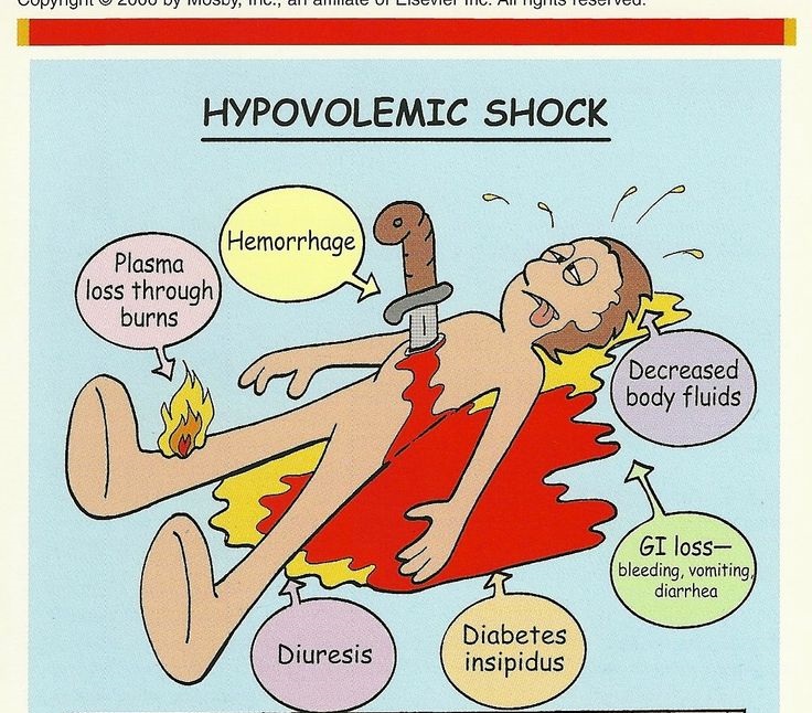  Șocul hipovolemic: cauze, diagnostic, tratament