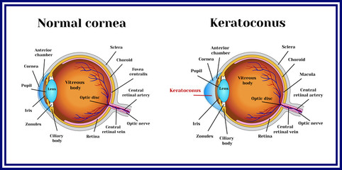 este posibilă restabilirea vederii cu keratoconus
