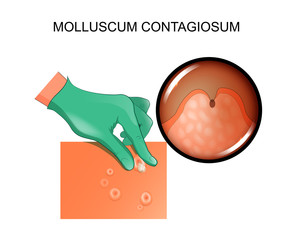  Infecția cu Molluscum contagiosum