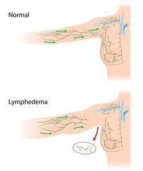Tapetarea drenajului limfatic al abdomenului