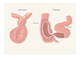 pierdere în greutate obstrucție parțială intestinală)