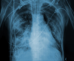  Pleurezia tuberculoasa: de la diagnostic la tratament