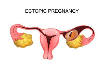  Sarcina extrauterină (ectopică)