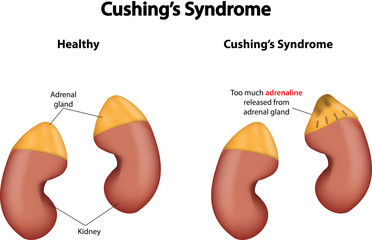 Sindromul Cushing: cauze, simptome si complicatii