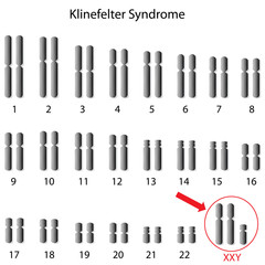  Sindromul Klinefelter – simptomatologie și diagnostic