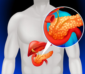  Cancerul de pancreas-simptome, diagnostic, tratament