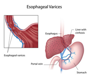  Varice esofagiene-cauză de hemoragie digestivă superioară