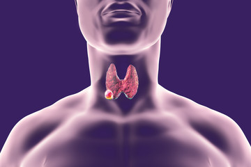  Cancerul tiroidian: cauze, diagnostic, tratament