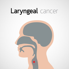 cancer laringian prognostic