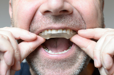  Gutiera dentară – definiție, tipuri și recomandări