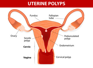  Polipii uterini – simptome, diagnostic, tratament