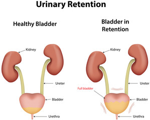 retentie urinara tratament
