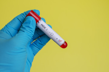  Hepatita virală G: date epidemiologice și clinice