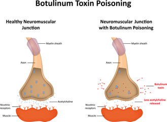 toxina botulinică și vederea