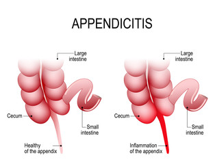 suspiciunea de apendicită)