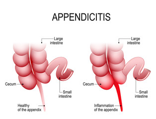  Apendicita acută – simptome, diagnostic, tratament