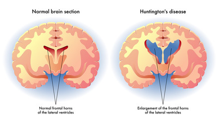 Boala Huntington (Coreea Huntington) -simptome, tratament – stilnatural.ro
