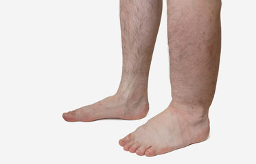 cauzele edemului piciorului în varicoză operațiuni varicleoza în dresn