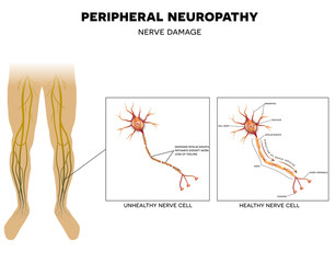 Neuropatia periferica, Neuropatie proximală și pierderea în greutate