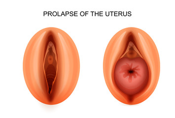  Prolaps uterin – cauze, simptome, tratament