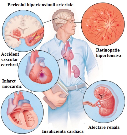 hipertensiune arterială a prostatei