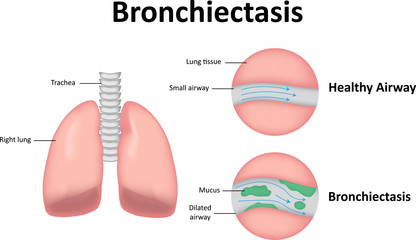  Bronșectazia: cauze, simptome, diagnostic, tratament