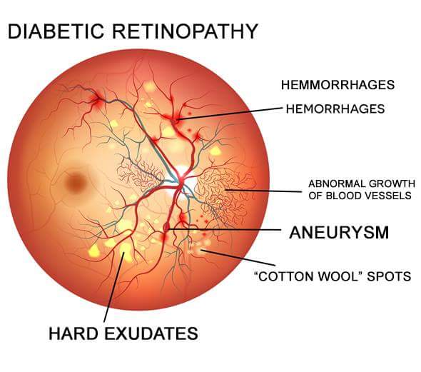  Retinopatia diabetică: diagnostic și tratament