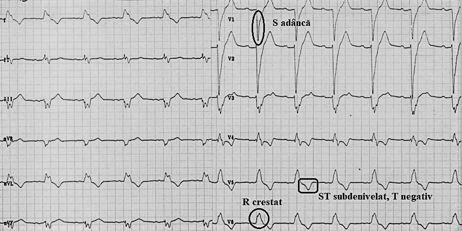 Interpretarea tulburărilor de conducere ale inimii pe EKG – noțiuni de fiziopatologie pentru studenți