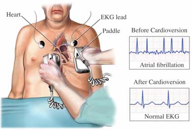  Cardioversia electrică: ce este, care sunt indicațiile?