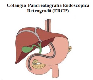  Colangio-pancreatografia endoscopică retrogradă (ERCP)