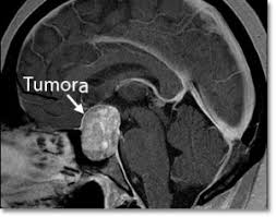 Profil oncologie (markeri tumorali) - Synevo