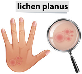 Lichenul plan – ce este, simptome, tratamentul de actualitate