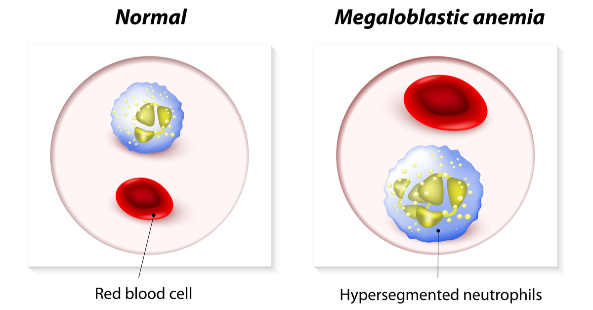 anemie megaloblastica