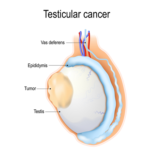 Cancerul Testicular Simptome Tratament Newsmed Ro