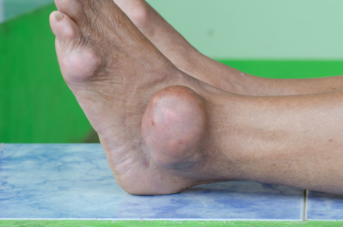 boala inflamatorie a articulațiilor este tratarea nămolului cu artroză la genunchi