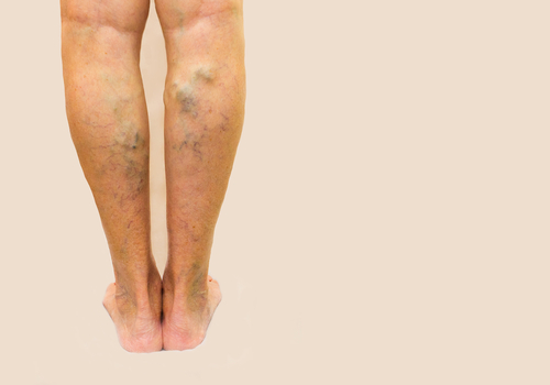 doctorul care trateaza picioarele varicoase simptomele vârstnicii varicoase