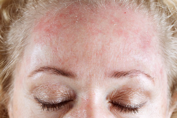 Dermatita seboreica scalp imagini