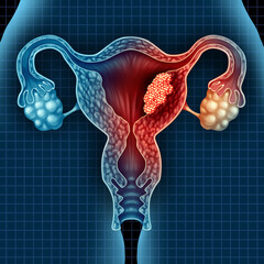 Cancerul endometrial – cauze, simptome, tratament